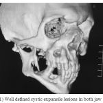 Figure 1: Well defined cystic expansile lesions in both jaw