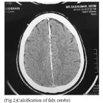 Figure 2a: Calcification of falx cerebri