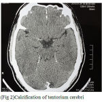 Figure 2b: Calcification of tentorium cerebri