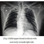 Figure 3: Mild upper dorsal scoliosis with convexity towards right side