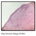 Figure 4: Cystic lining of OKC