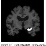 Figure 10: Hihglighted left Hippocampus