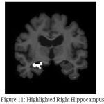 Figure 11: Highlighted Right Hippocampus