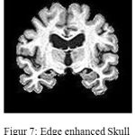 Figure 7: Edge enhanced Skull stripped Image
