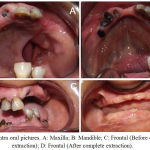 Figure 1: Intra oral pictures. A: Maxilla; B: Mandible; C: Frontal (Before complete extraction); D: Frontal (After complete extraction)