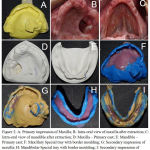 Figure 2: A: Primary impression of Maxilla; B: Intra-oral view of maxilla after extraction; C: