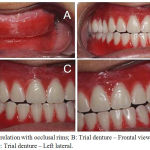 Figure 3: A: Jaw relation with occlusal rims; B: Trial denture – Frontal view; C: Trial denture – Right lateral; D: Trial denture – Left lateral