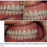 Figure 5: Intra oral pictures of dentures in patient’s mouth. A: Right Lateral; B: Left lateral; C: Frontal view