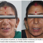 Figure 6: Extra oral pictures of patient. A: Frontal (Before treatment); B: Profile (Before treatment); C: Frontal (After treatment); D: Profile (After treatment)