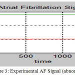 Figure 3: Experimental AF Signal (abnormal)