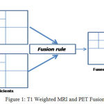 Figure 1: T1 Weighted MRI and PET Fusion