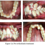 Figure 1a: Pre orthodontic treatment