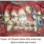 Figure 1d: Present status after achieving ideal overbite and overjet