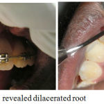Figure 2b: IOPAR i.r.t. 21 revealed dilacerated root