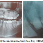 Figure 2c: Full thickness mucoperiosteal flap reflected