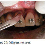 Figure 2d: Dilaceration seen