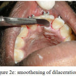 Figure 2e: smoothening of dilacerations
