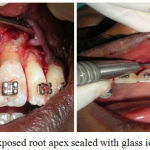 Figure 2f: Exposed root apex sealed with glass ionomer cement