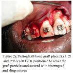 Figure 2g: Perioglas® bone graft placed i.r.t. 21 and Periocol® GTR positioned to cover the graft particles and sutured with interrupted and sling sutures