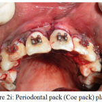 Figure 2i: Periodontal pack (Coe pack) placed