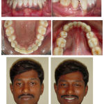 Figure 2j: Post op after 3 months follow up of periodontal surgery