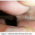 Figure 1: Infected skin between foot toes.