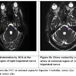 Role Of Magnetic Resonance Imaging In Evaluation Of Trigeminal 