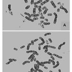 Figure 1:(A, B) Philadelphia chromosome t(9:22) of CML Patients.