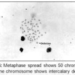 Figure 4: Metaphase spread shows 50 chromosomes and one chromosome shows intercalary deletion.