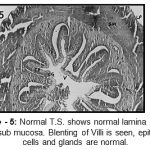 Figure 5: Normal T.S. shows normal lamina propria and sub mucosa. Blenting of Villi is seen, epithelial cells and glands are normal.