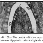 Figure 8: 100x- The central villi show normal villus pattern however dysplastic cells and glands are seen.