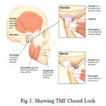 Figure 1: Showing TMJ Closed Lock
