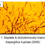 Figure 1: Septate & dichotomously branching Aspergillus hyphae (GMS)