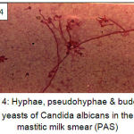 Figure 4: Hyphae, pseudohyphae & budding yeasts of Candida albicans in the mastitic milk smear (PAS)