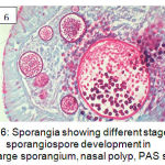 Figure 6: Sporangia showing different stages of sporangiospore development in the large sporangium, nasal polyp, PAS stain.