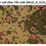 Figure 4: Tumor cell after 72h with[Mn(C13H11N2O)2]2+ compound