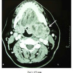 Figure 1: CT scan