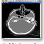 Figure 13:CT Target Image(courtesy-3D DOCTOR SOFTWARE)