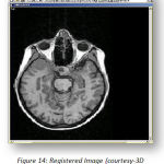 Figure 14:Registered Image(courtesy-3D DOCTOR SOFTWARE)