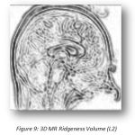 Figure 9: 3D MR Ridgeness Volume (L2)