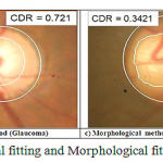 Figure 5: Images of Elliptical fitting and Morphological fitting (Normal and Glaucoma)