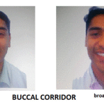 Buccal Coridor