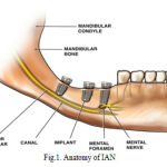 Fig.1. Anatomy of IAN