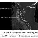 Figure 1. CT scan of the cervical spine revealing posteriorly displaced C7 vertebral body impressing spinal cord.