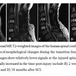 Figure 2. Conventional MR T2-weighted images of the human spinal cord with trauma show characteristic stages of morphological changes during the transition from acute to chronic stages of injury. Images show relatively lower signals at the injured spinal cord at A) acute phase which gradually increased in the time post-injury include B) 2 weeks after SCI, C) 5 months after SCI, and D) 18 months after SCI.