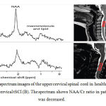 Figure 4. 1H-MR spectrum images of the upper cervical spinal cord in healthy volunteer (A) and patient with cervical tSCI (B). The spectrum shows NAA/Cr ratio in patients with tSCI was decreased.