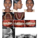 Figure 1: Pretreatment Extraoral and Intraoral records