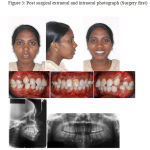 Figure 3: Post surgical extraoral and intraoral photograph (Surgery first)