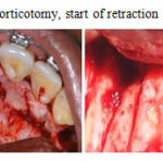 Figure 3: Maxillary corticotomy, start of retraction 1 week post operative