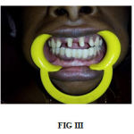 FIG III – Tooth preparation